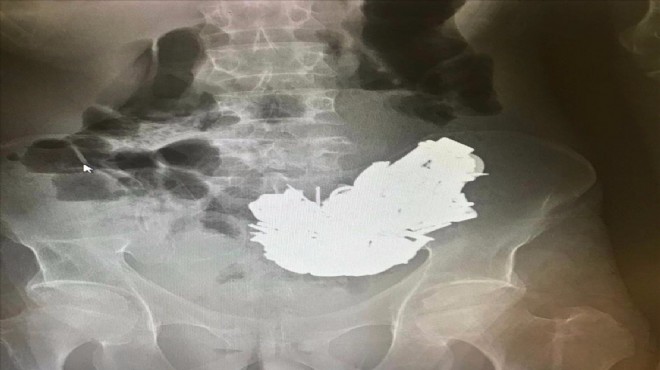 Midesinden 200 e yakın metal cisim çıkarılan hasta kurtarılamadı