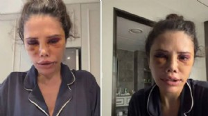 Didem Ceran estetik ameliyatını anlattı